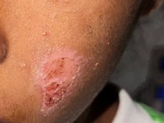 Lesão visível na bochecha de uma criança, resultado de abuso físico, com casal preso na cidade de Barra, na Bahia